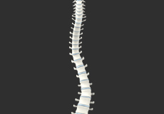 Adult Degenerative Scoliosis