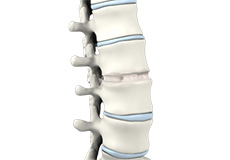 Anterior Lumbar Interbody Fusion