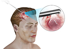 Nerve Biopsy