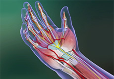 Carpal Tunnel Release