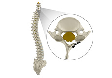 Cervical Laminoplasty