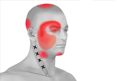 Cervicogenic Headache