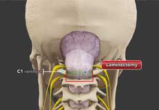 Chiari Malformation