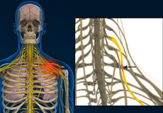 Compression of Thoracic Nerve