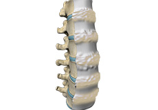 Idiopathic Scoliosis