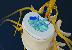 Herniated Disc (Lumbar)