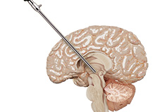 Endoscopic Brain Surgery