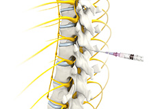 Epidural Steroid Injections