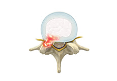 Lumbar Disc Herniation