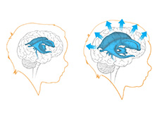 Hydrocephalus