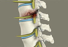 Spinal Infection