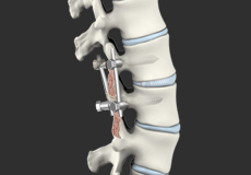 Lumbar Interbody Fusion