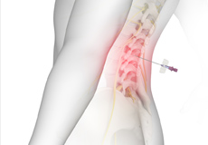 Lumbar Epidurals