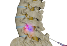 Lumbar Facet Block