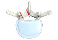 Lumbar Foraminotomy