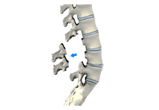 Lumbar Laminectomy