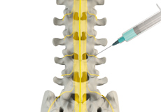 Lumbar Medial Branch Block