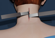 Neck Surgery