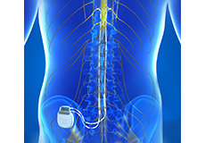 Peripheral Nerve Stimulation