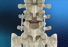 Posterolateral Lumbar Fusion