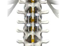 Posterior Thoracic Fusion