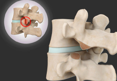 Removal of Facet Joint Cyst