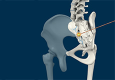 Sacroiliac Joint Radiofrequency Ablation
