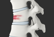 Spinal Fractures