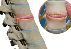 Spinal Infection Debridement