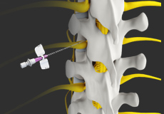 Spine Injections