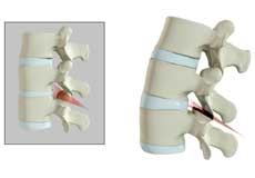 Spine Osteotomy