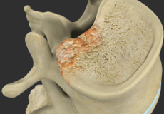 Benign Spinal Tumors