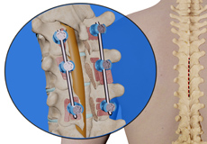 Thoracic Corpectomy