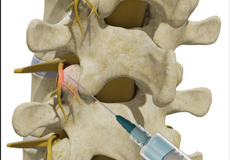 Thoracic Facet Joint Injection