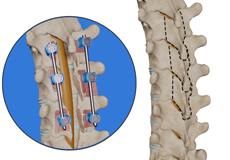 Thoracic Laminectomy