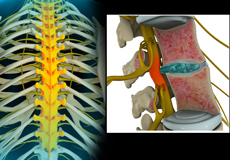 Thoracic Nerve Compression