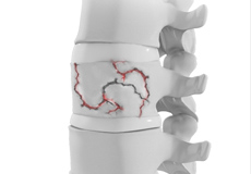 Thoracic Spine Trauma Surgery