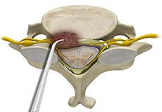 Tumour Decompression