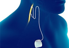 Vagus Nerve Stimulation (VNS) for Epilepsy