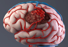 Vascular Brain Tumor